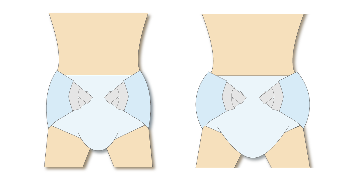尿失禁パッドの重ね使いで股部分が厚くなる様子