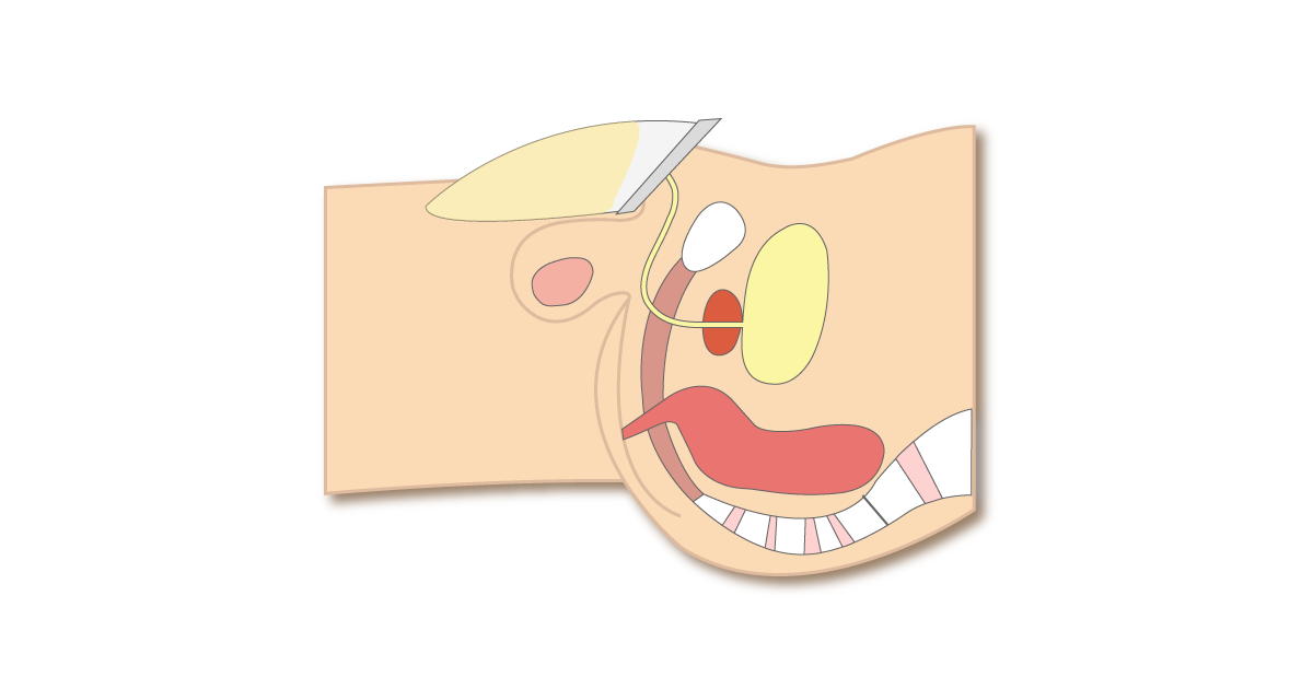 男性用パッドで尿が臀部まで広がるのを防ぐ位置のイラスト