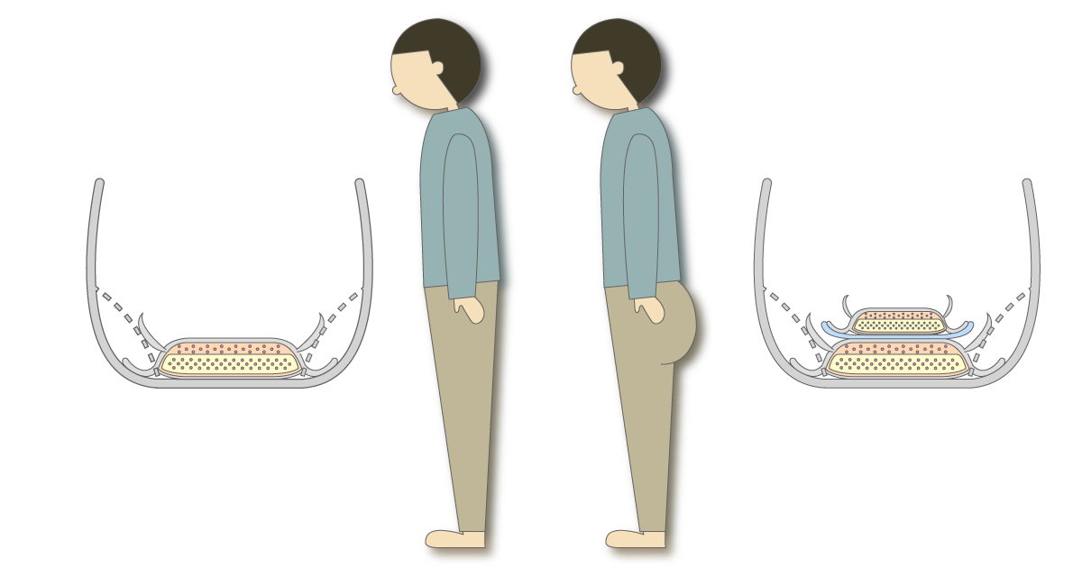 パンツ型紙おむつとパッドの重ね使いでお尻が膨らむ様子