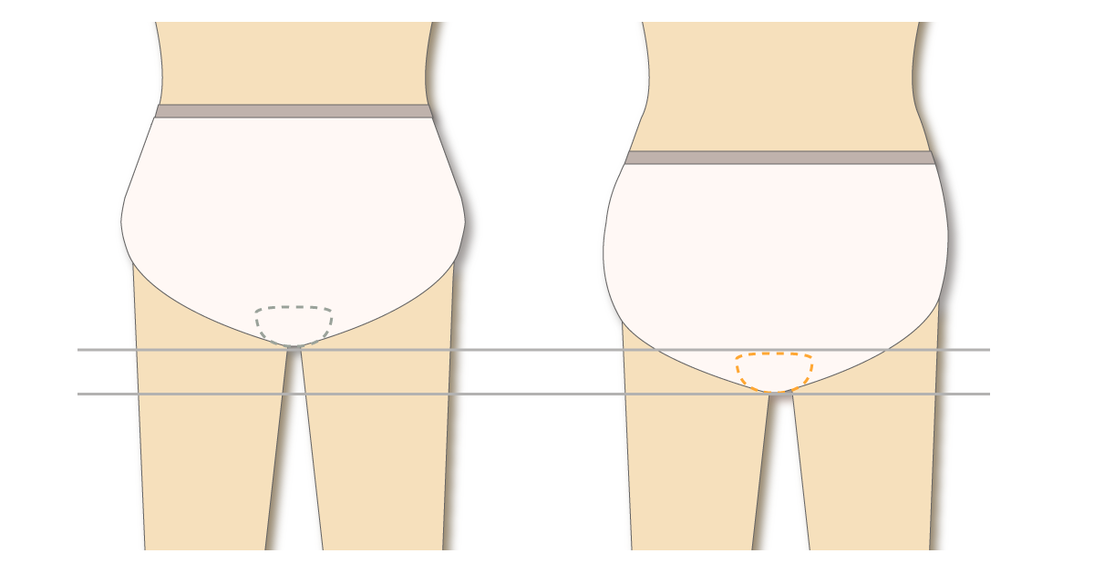パッドがずれ落ちる状態のイラスト