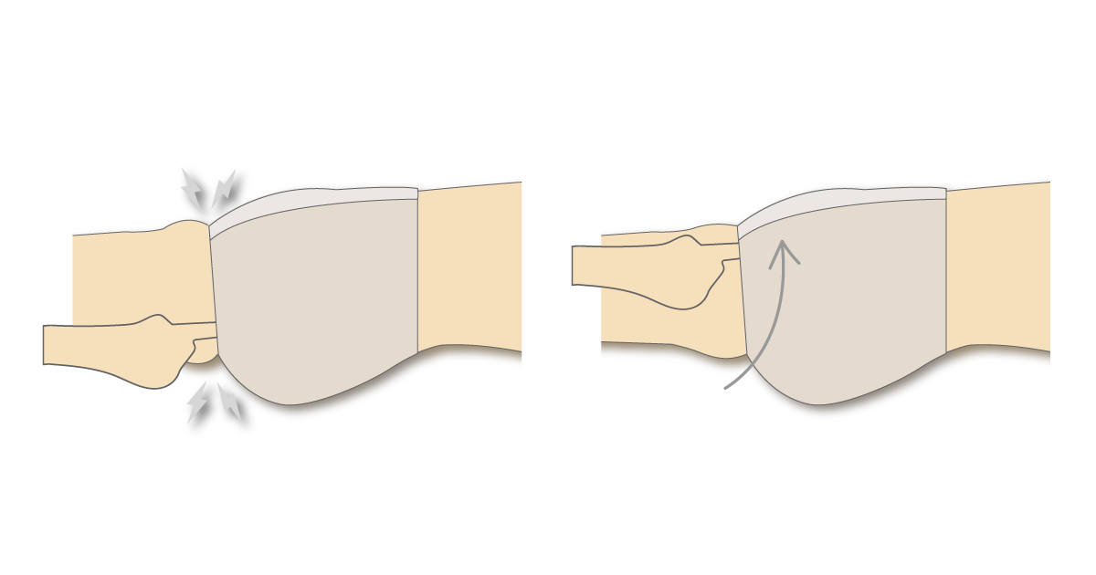 Inserting a finger under the thigh elastic to relieve pressure