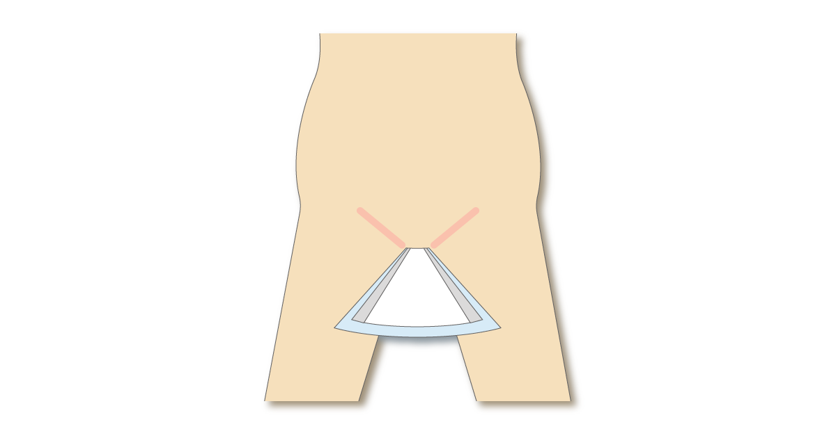 立体ギャザーが肌に当たり赤みが出る例の図
